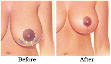Insurance, Reconstructive Surgery, Breast Implant, Breast Reduction Surgery Mumbai India